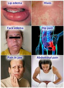 Fosamax side effects