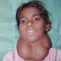 Hypothyroidism