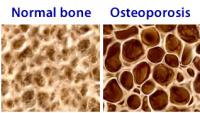 Osteoporosis