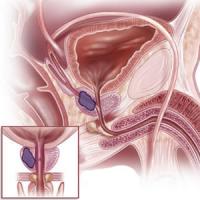 Prostate cancer