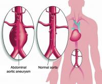 Abdominal aortic aneurysm