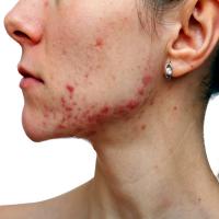 Acne on face