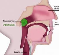 Adenoids