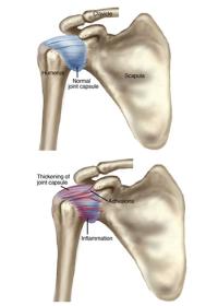 Adhesive capsulitis