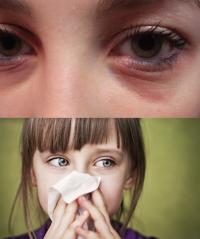 Allergic rhinitis