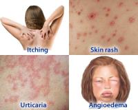 Allergy symptoms