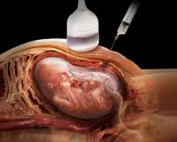Amniocentesis