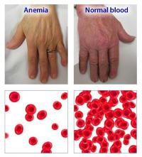 Anemia