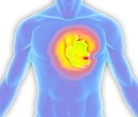 Angina