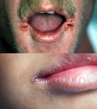 Angular cheilitis symptoms