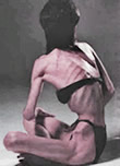 Anorexia