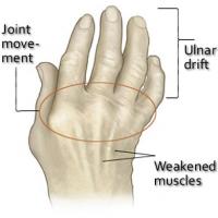 Arthritis in hands