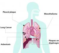 Asbestos-related lung diseases