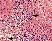 Autoimmune hepatitis