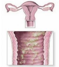Bacterial vaginosis