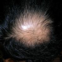 Baldness