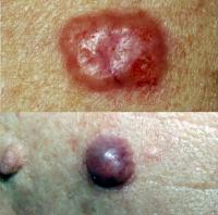 Basal cell carcinoma