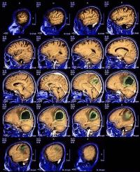 Brain tumor