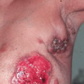 Breast cancer