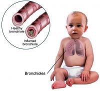 Bronchiolitis