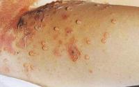 Bullous Impetigo