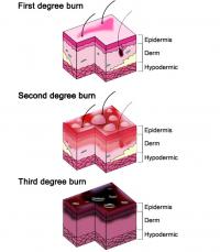 Burns degree