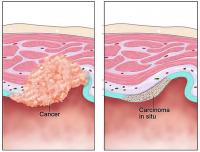 Cancer and carcinoma