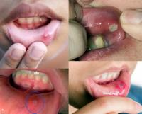 Canker sores