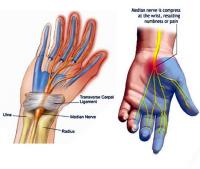 Carpal tunnel syndrome