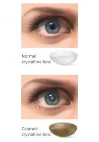 Cataract eye