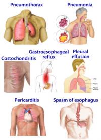 Chest pain causes