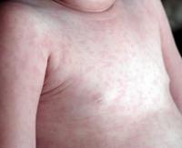 Childhood roseola