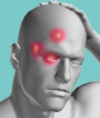 Cluster headache
