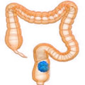 Colon cancer
