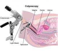 Colposcopy