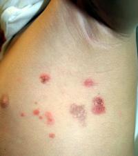 Common impetigo