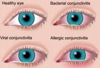 Conjunctivitis symptoms