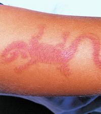 Contact dermatitis on hand