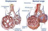 COPD