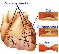 Coronary arteries