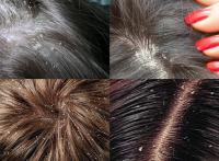Dandruff
