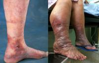 Deep vein thrombosis