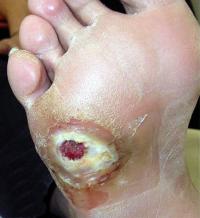 Diabetic foot ulcer
