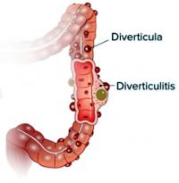 Diverticulitis in large intestine