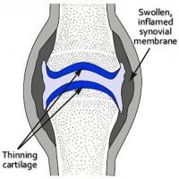 Early stage arthritis