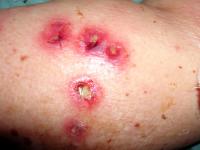 Ecthyma