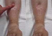 Edema