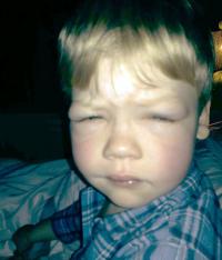 Edema around eyes
