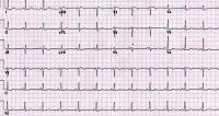 Electrocardiogram