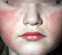 Erythema infectiosum